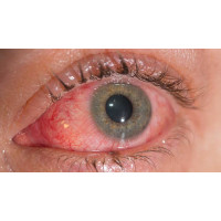 Глаза воспалены, зудят и гноятся: как отличить инфекцию от аллергии