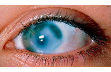 Глаукома и катаракта: что делать?